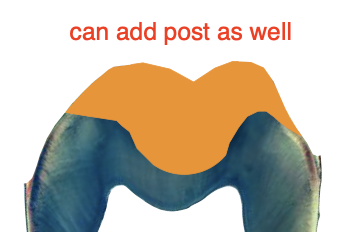 <p>Foundation restoration which restores sufficient coronal anatomy of a vital or endodontically treated tooth</p>