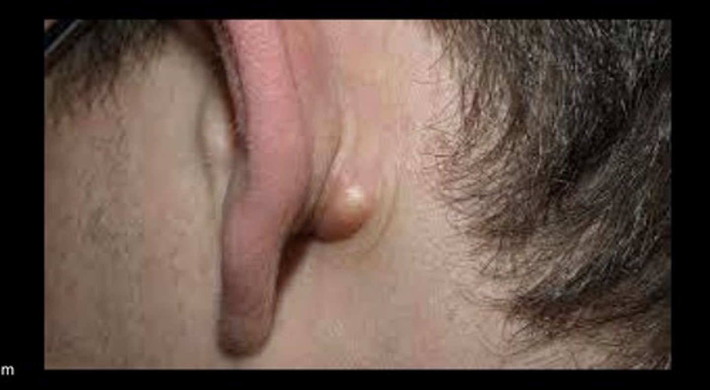 <p>Benign, closed, firm sac, dome shape lump</p><p>In dermis, attached to epidermis</p><p>Possible inflammation</p>