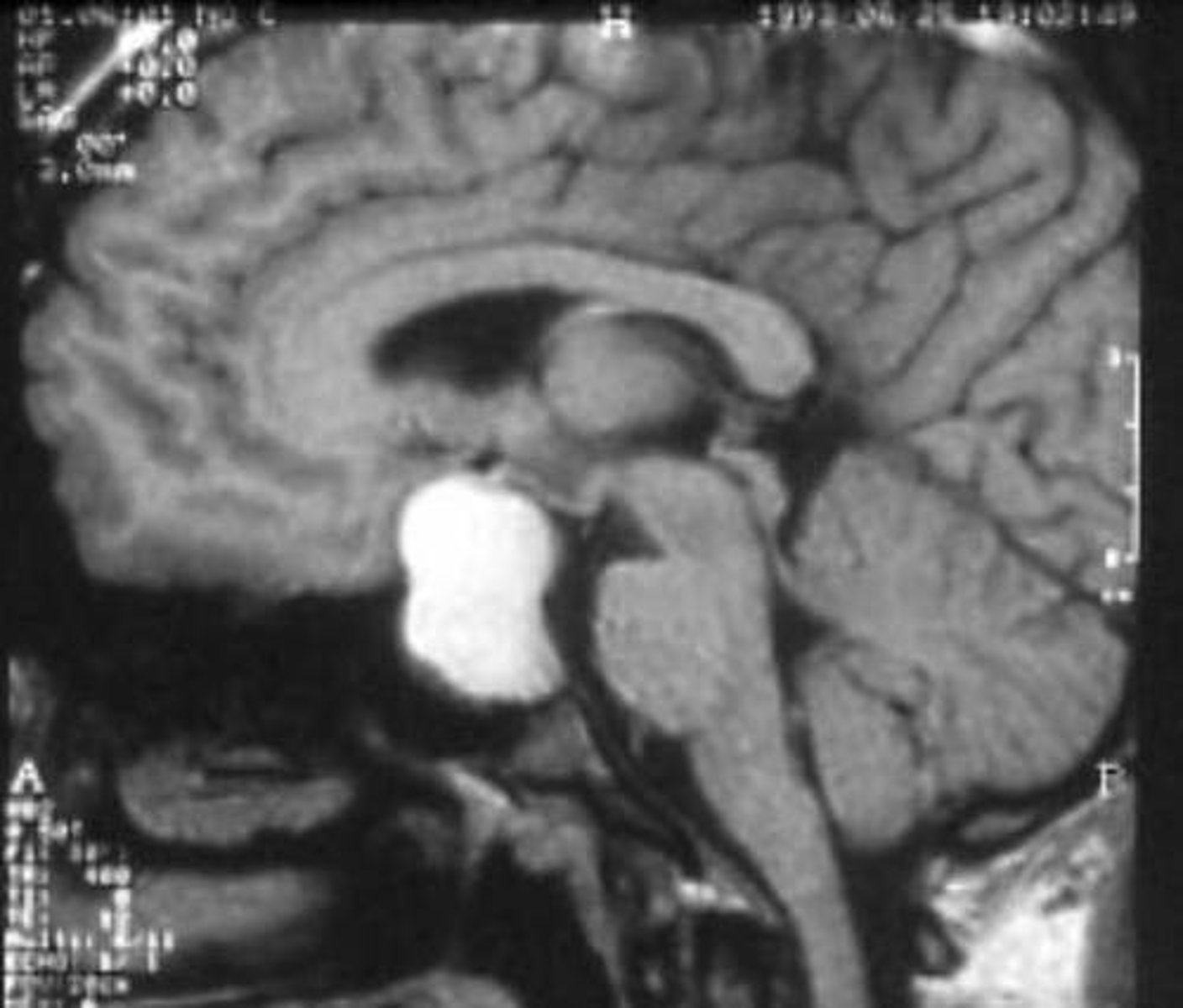 <p>Define Cause of Hypopituitarism:</p><p>Rare, BENIGN tumor of CNS</p><p>-Hx: MC Childhood Supratentorial Tumor</p><p>BIMODAL AGE:</p><p>&gt; 5-14</p><p>&gt; 50-74</p><p>-Path: Derived from remnants of Rathke's Pouch</p><p>-Sx/PE:</p><p>&gt; HA</p><p>&gt; Bitemporal Hemianospia</p><p>&gt; Hypopituitarism</p><p>-Tx: Surgical Resection</p>