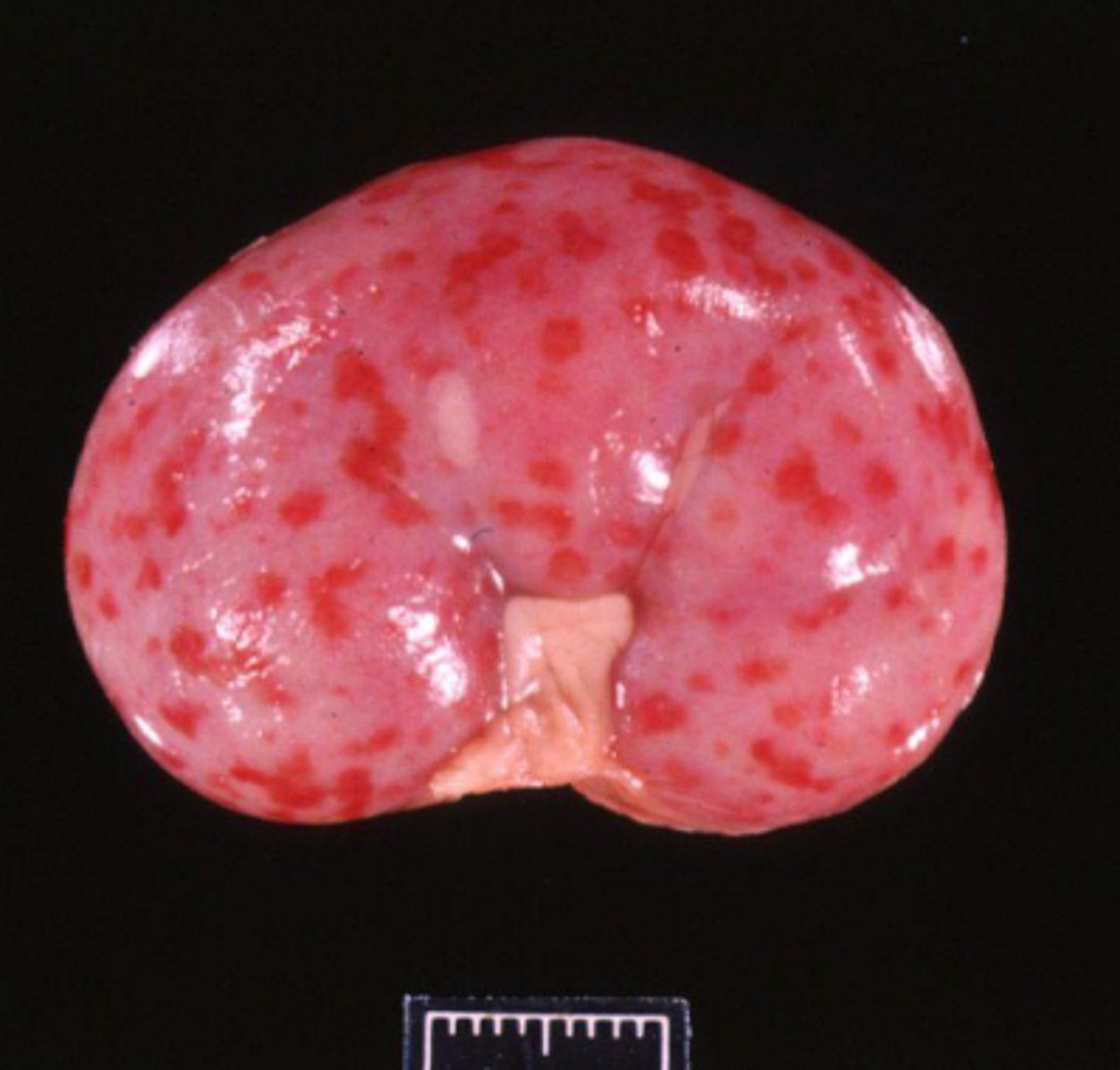 <p>What type of blood spot on this kidney?</p>