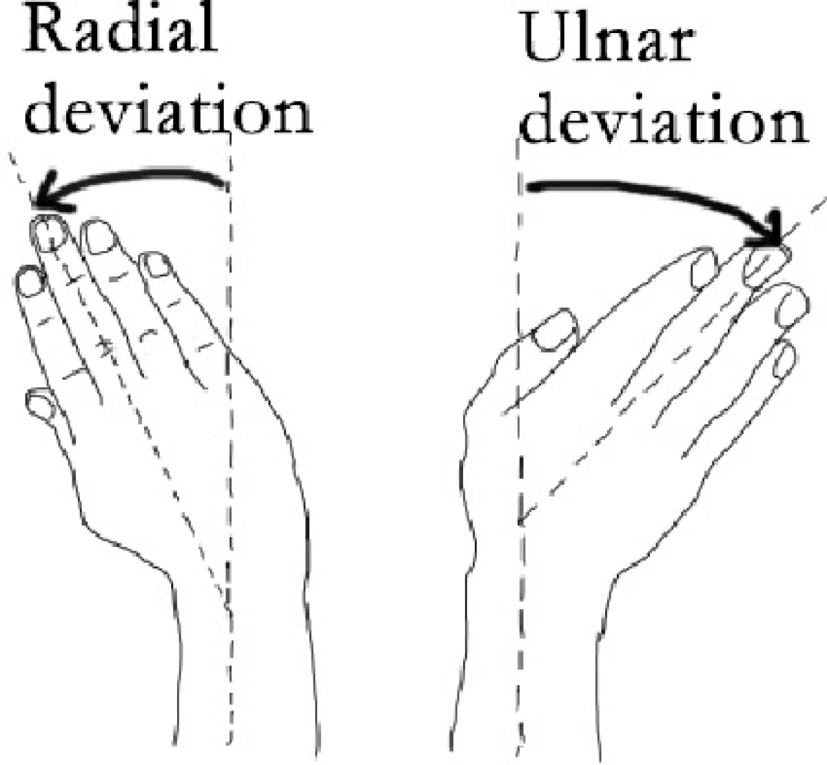 <p><span>ulnar deviation</span></p>