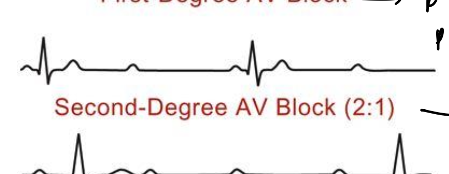 <ul><li><p>every two P wave is a QRS wave</p></li><li><p>half of the action potentials are blocked by the AV node</p></li></ul><p></p>