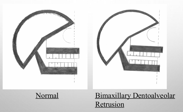 <p>-present when the anterior teeth are posterior to the normal limits of the basal bone</p><p>-bimaxillary dentoalveolar retrusion: present when the anterior teeth of both jaws are posterior to the normal limits of the basal bone</p><p>-maxillary dentoalveolar retrusion: present when the anterior teeth of the maxilla are posterior to the normal limits of the basal bone</p><p>-mandibular dentoalveolar retrusion: present when the anterior teeth of the mandible are posterior to the normal limits of the basal bone</p>