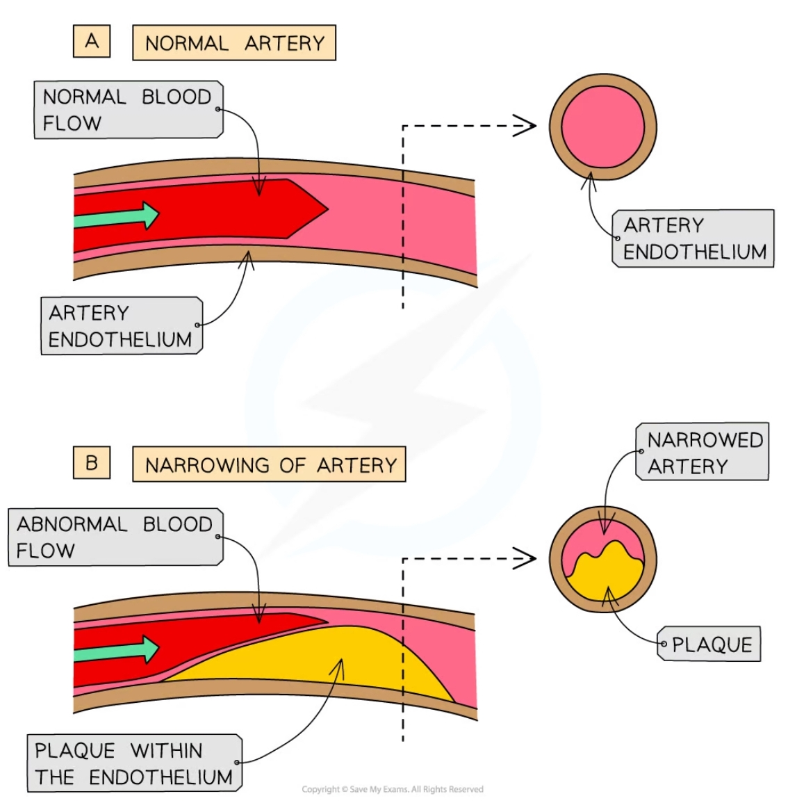 * Damage to the endothelium (due to high blood pressure), cholesterol accumulates and oxidises causing an inflammatory response
* Lipids and cholesterol accumulate in the damaged area
* White blood cells (macrophages) enter the endothlium, attempt to digest cholesterol and turn into foam cells
* Foam cells degenerate and form the atheroma t on the endothelium wall
* Plaque ruptures and platelets accumulate and form a plaque called an atheroma
* Atheroma narrows lumen of the artery, raising lood pressure and reducing blood flow
* Plaque hardens over time further reducing easticity of artery wall