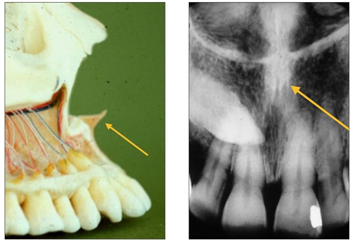 <p>Anterior nasal spine</p><ul><li><p>a sharp projection of the maxilla located at the anterior and inferior portion of the nasal cavity</p></li><li><p><u>Radiography: V-shaped radiopaque area located at the intersection of the floor of the nasal cavity and nasal septum.</u></p></li></ul><p></p>