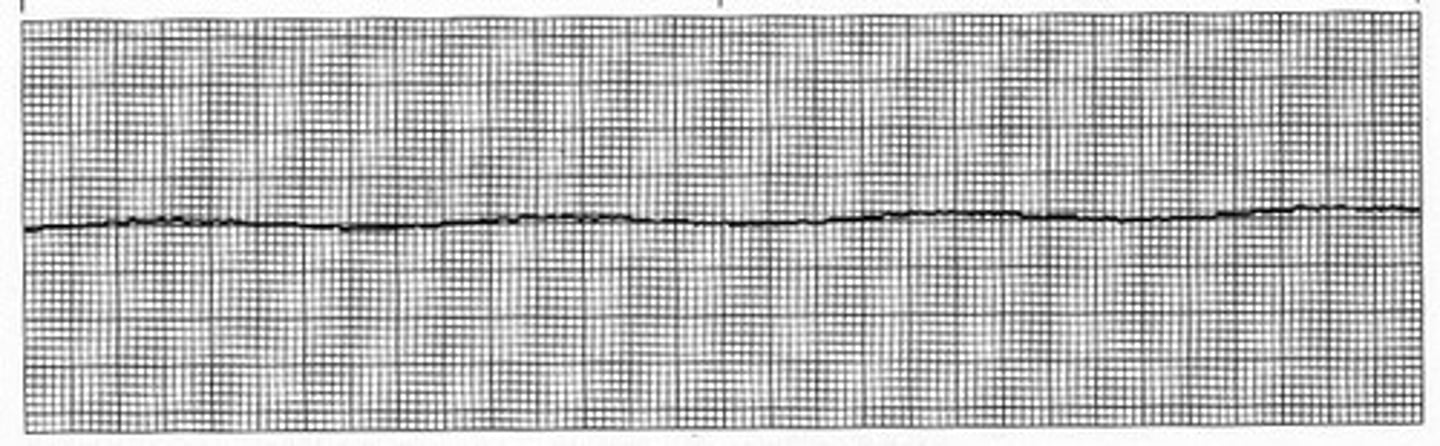 <p>what rhythm is this?</p><p>no electrical activity at all in the heart.</p><p>cannot shock as their is no electrical activity in the heart to "reset"</p><p>TX: epinephrine, CPR</p>