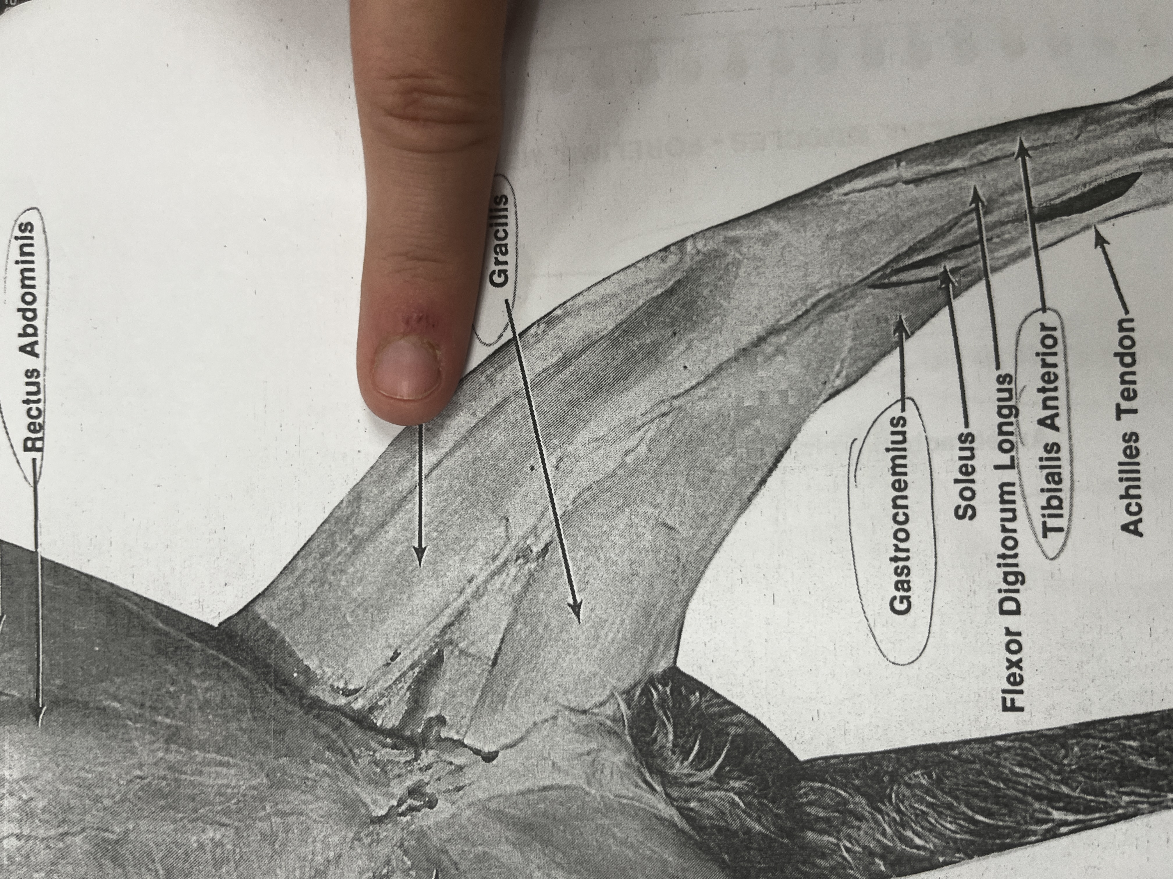 <p>A long, thin muscle that runs down the length of the thigh and aids in hip and knee flexion.</p>