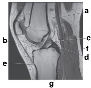 <p>Which letter is pointing to the anterior cruciate ligament?</p>