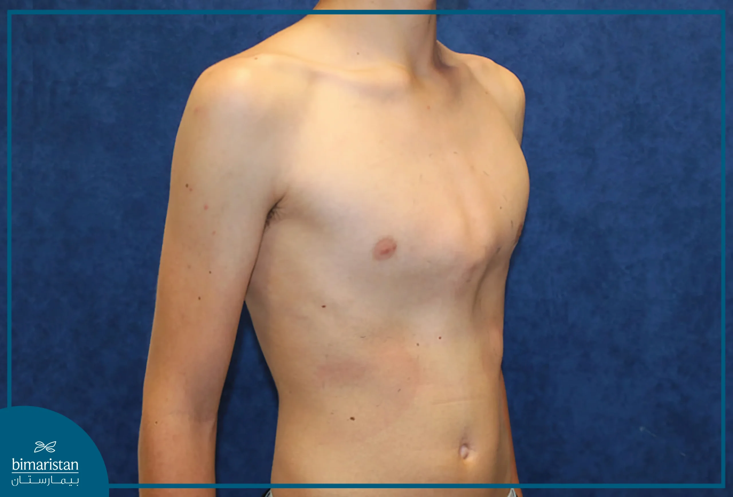 <p>What is another name for pigeon chest?</p>