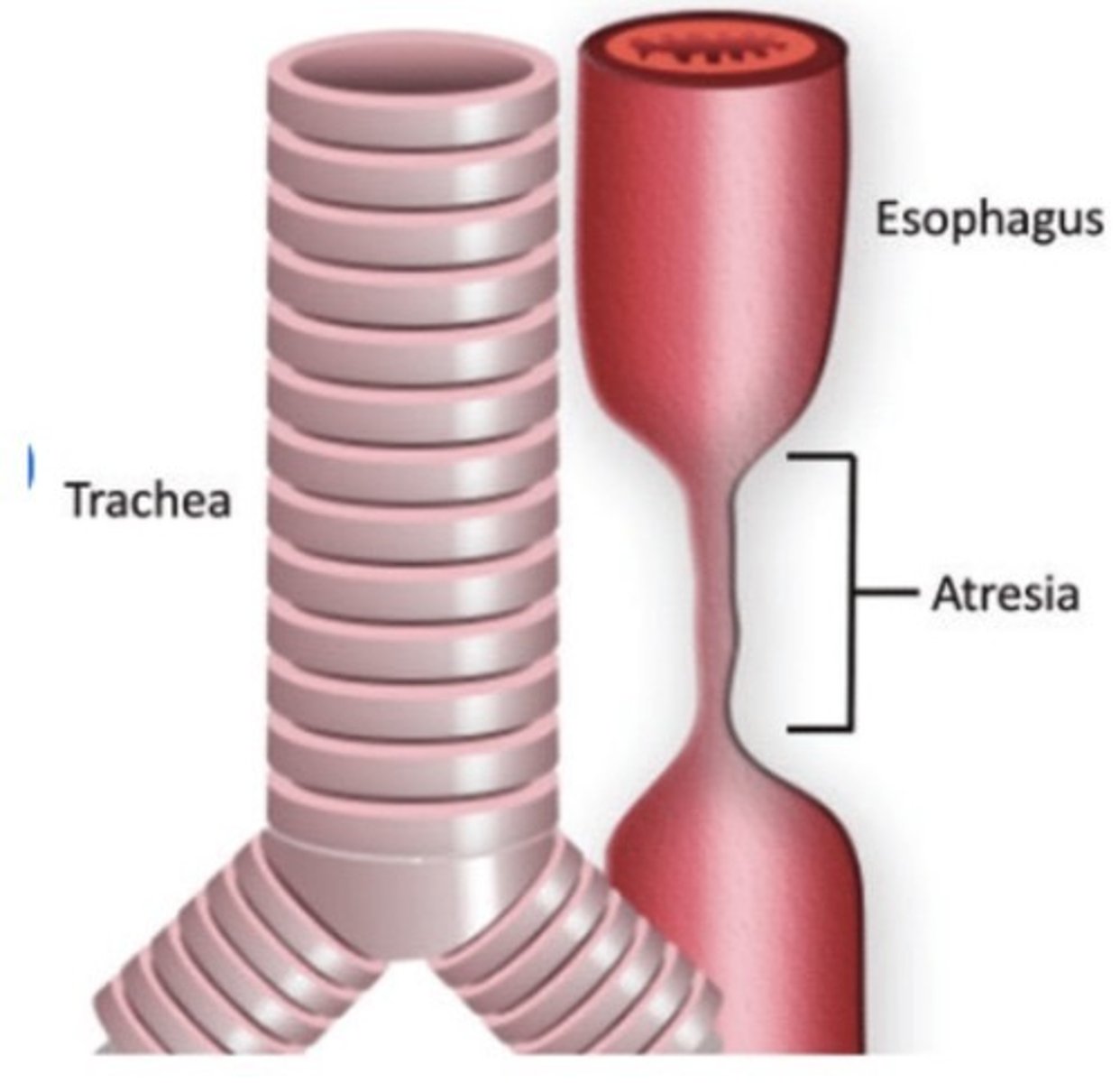 <p>Stenosis in esophagus</p><p>Stomach is not visualized</p>