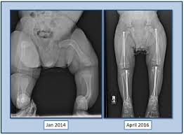 <p>when some egg or sperm cells carry a mutation and others do not</p><p>-parents will have no phenotype typically as the mutation would only have an impact on somatic cells </p><p>-depending on which gamete is fertilized, offspring may be affected (mom vs dad)</p><p>-example of osteogenesis imperfecta</p>