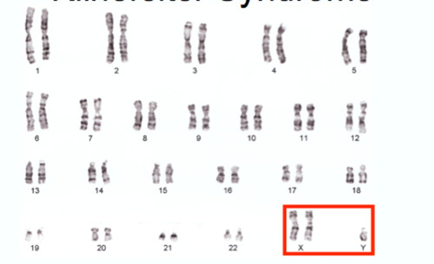<p>A chromosomal disorder in which males have an extra X chromosome, making them XXY, XXXY, or XXYY instead of XY.</p>
