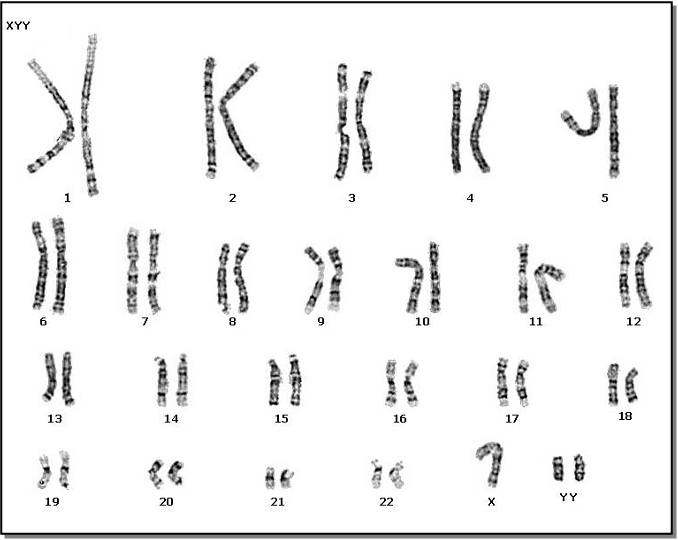 <p>XYY Males </p><p>1 in 1000 live male births</p><p>extra Y chromosome</p><p>slightly taller than average</p><p>more active</p><p>normal intelligence, slight learning disabilities</p><p>delayed emotional maturity</p><p>normal sexual development</p><p></p>