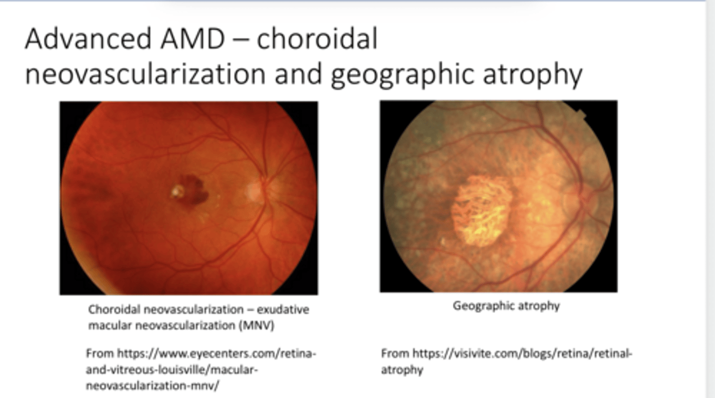 <p>Advanced AMD w/ Choroidal Neovasc &amp; Geographic Atrophy (Pic)</p>