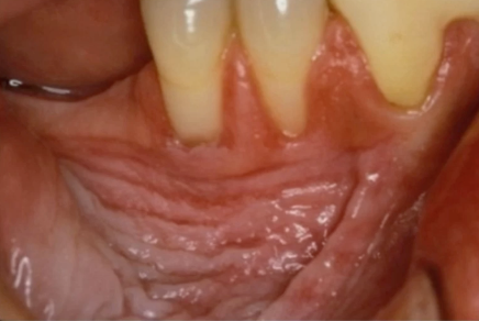 <p>what is the management if there is a focal area that looks different </p>