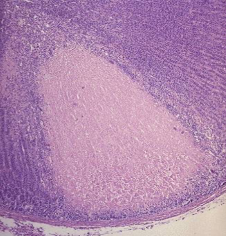 <p>What kind of necrosis is this</p>