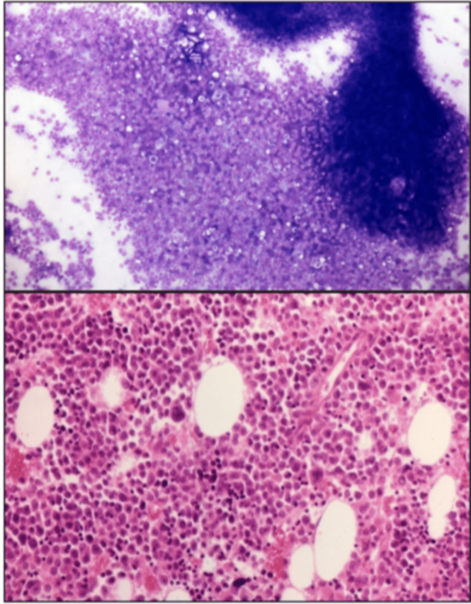 <p>If bone marrow particles, on average, are < 25 % adipose tissue</p>