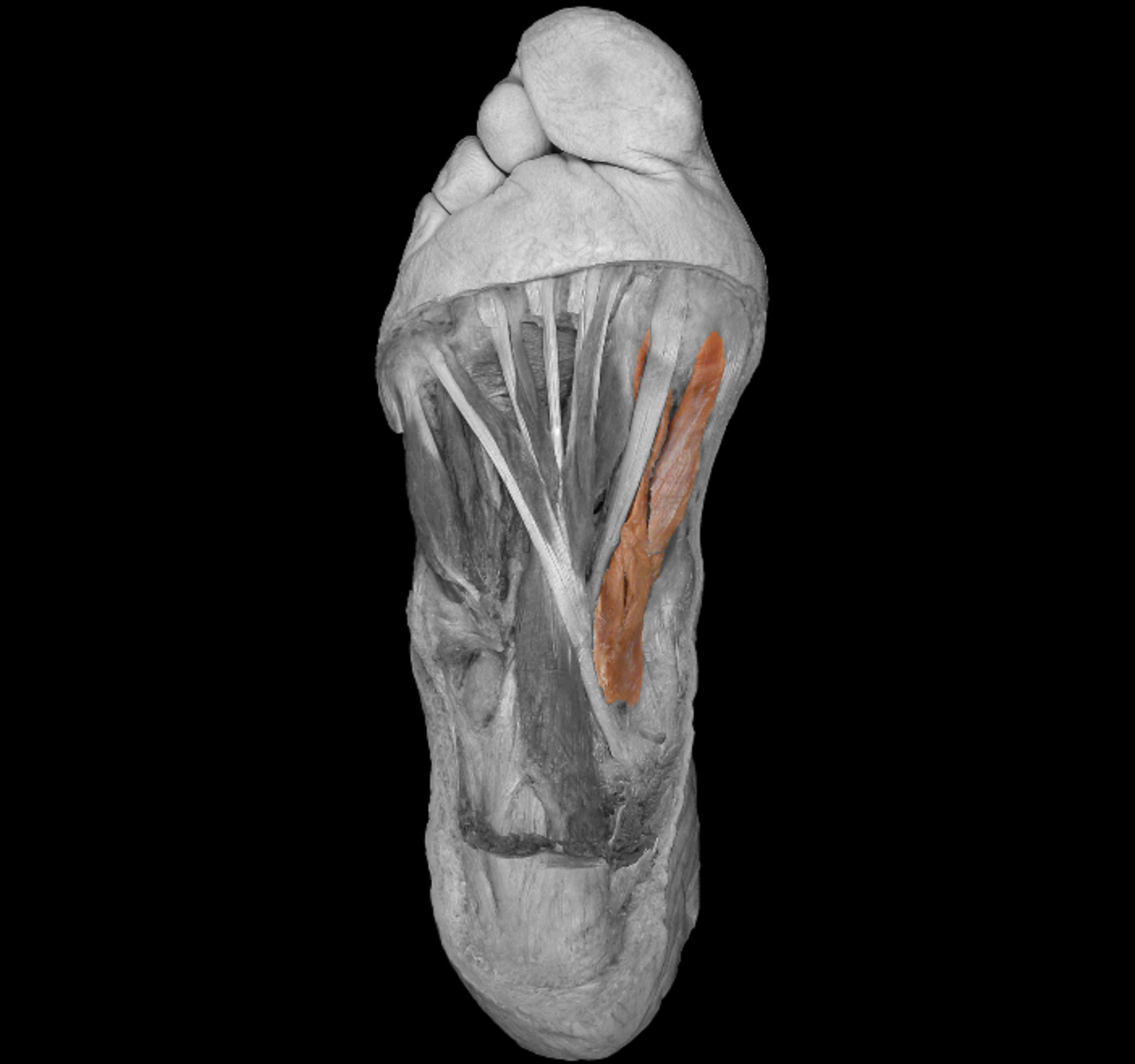 <p>origin: cuboid, lateral cuneiform </p><p></p><p>insertion: proximal phalanx of big toe </p><p></p><p>action: flex big toe </p><p></p><p>innervation: medial plantar nerve </p>