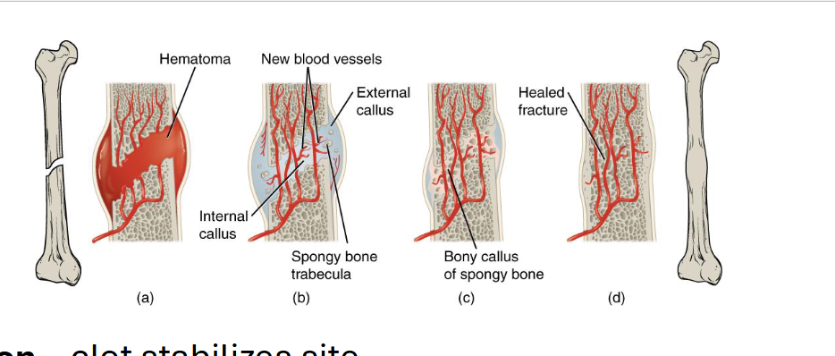 <p><strong>Hematoma Formation </strong>- Clot stabilizes site</p><p><strong>Fibrocartilaginous callus </strong>- connective tissue bridge</p><p><strong>Bony callus formation</strong> - spongy bone replaces cartilage</p><p><strong>Remodeling -</strong> Compact bone restores original shape</p>
