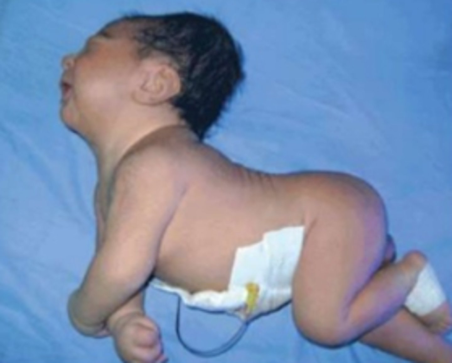 <p>Condition with increased muscle tone and seizures in an infant.</p>