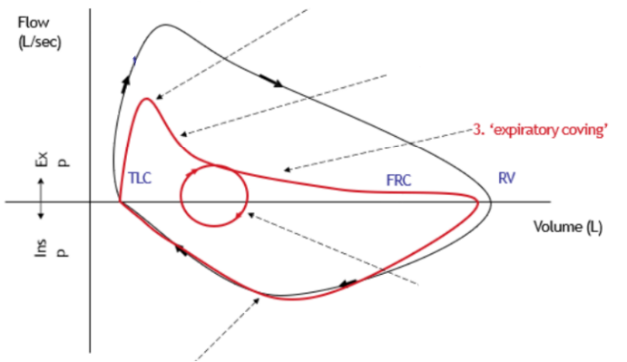 <p>Indicative of emphysema</p><p>PEF to RV is no longer a linear line</p>