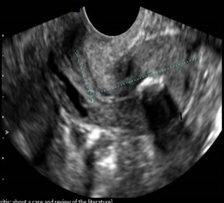 <p>what is the 1st stage of PID identified sonographically</p><p>a) endometritis</p><p>b) tubo-ovarian abscess</p><p>c) hydrosalpinx</p><p>d) pyosalpinx</p>