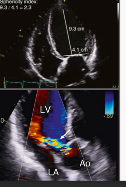 <p>Significant compensatory LV dilation and</p><p>increased sphericity of the LV are seen in the</p><p>apical four-chamber view with chronic severe</p><p>AR</p>