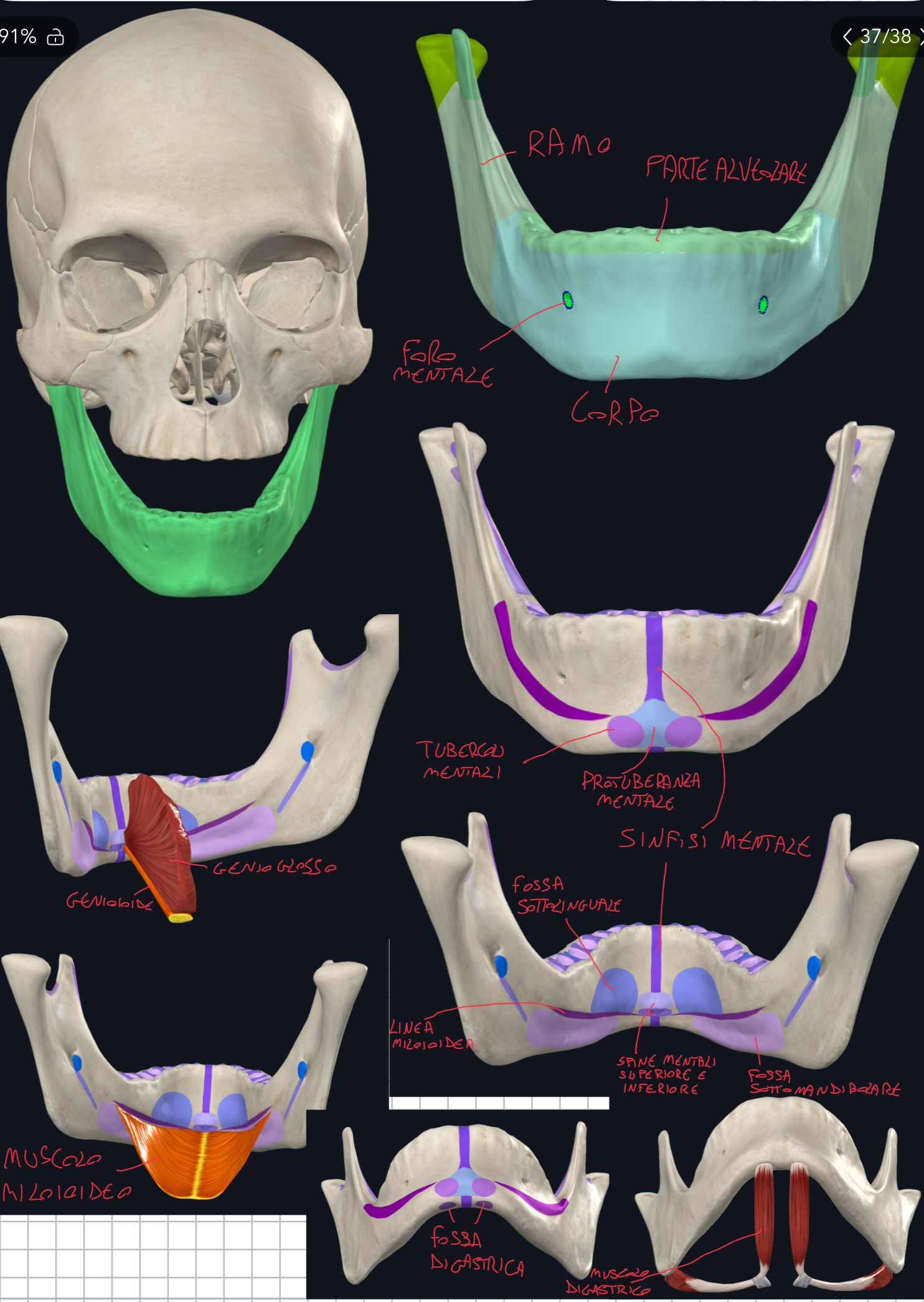 <p>Generalità:</p><ul><li><p>Unico osso mobile del cranio</p></li><li><p>Forma con l’osso temporale l’articolazione temporo-mandibolare (ATM), un’articolazione sinoviale (diartrosi)</p></li><li><p>Ha una forma a ferro di cavallo:</p><ul><li><p>Corpo orizzontale</p></li><li><p>Rami verticali</p></li></ul></li></ul><p>Corpo:</p><ul><li><p>Sinfisi Mentale → linea mediana dove si saldano le due metà embrionali</p></li><li><p>Porzione Alveolare → che contiene gli 8 alveoli dentali per lato (arcata inferiore)</p></li><li><p>Foro Mentale (o mentoniero) → sbocco anteriore del canale mandibolare → passano nervi e vasi mentali (innerva cute del mento e labbro inferiore)</p></li><li><p>Protuberanza Mentale → rilievo osseo mediano esterno a livello del mento → forma triangolare → ai lati presenta i Tubercoli Mentali, piccoli rilievi arrotondati</p></li><li><p>Spine Mentali (superiore e inferiore) → sono invece piccoli rilievi interni al corpo della mandibola → servono da inserzione per muscoli (rispettivamente il muscolo genioglosso e genioioideo che si portano per lingua e osso ioide)</p></li><li><p>Linea Miloioidea → linea obliqua interna → punto di inserzione per il muscolo miloioideo (forma il pavimento della bocca)</p></li><li><p>Fossa Sottolinguale → sopra la linea miloioidea → accoglie la ghiandola sottolinguale</p></li><li><p>Fossa Sottomandibolare → sotto la linea miloioidea → accoglie la ghiandola sottomandibolare</p></li><li><p>Fossa Digastrica → sul margine inferiore → accoglia il ventre anteriore del muscolo digastrico</p></li></ul><p></p>