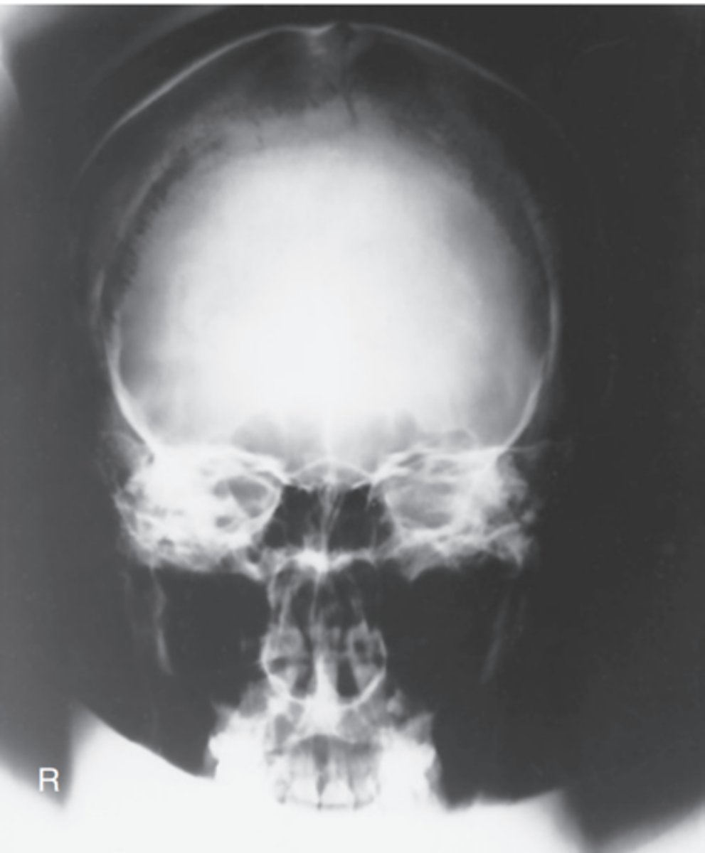 <p>-Position:</p><p>• No rotation is evident, as indicated by equal distance bilaterally from lateral orbital margin to lateral cortex of skull.</p><p>• Petrous portion of temporal bone fills the orbits with the petrous ridges at the level of the supraorbital margin.</p><p>• Posterior and anterior clinoids are visualized just superior to ethmoid sinuses</p>