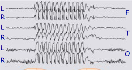 <p>EEG pattern reflects neural oscillations between thalamus and cortex and is due to T type calcium channels</p>