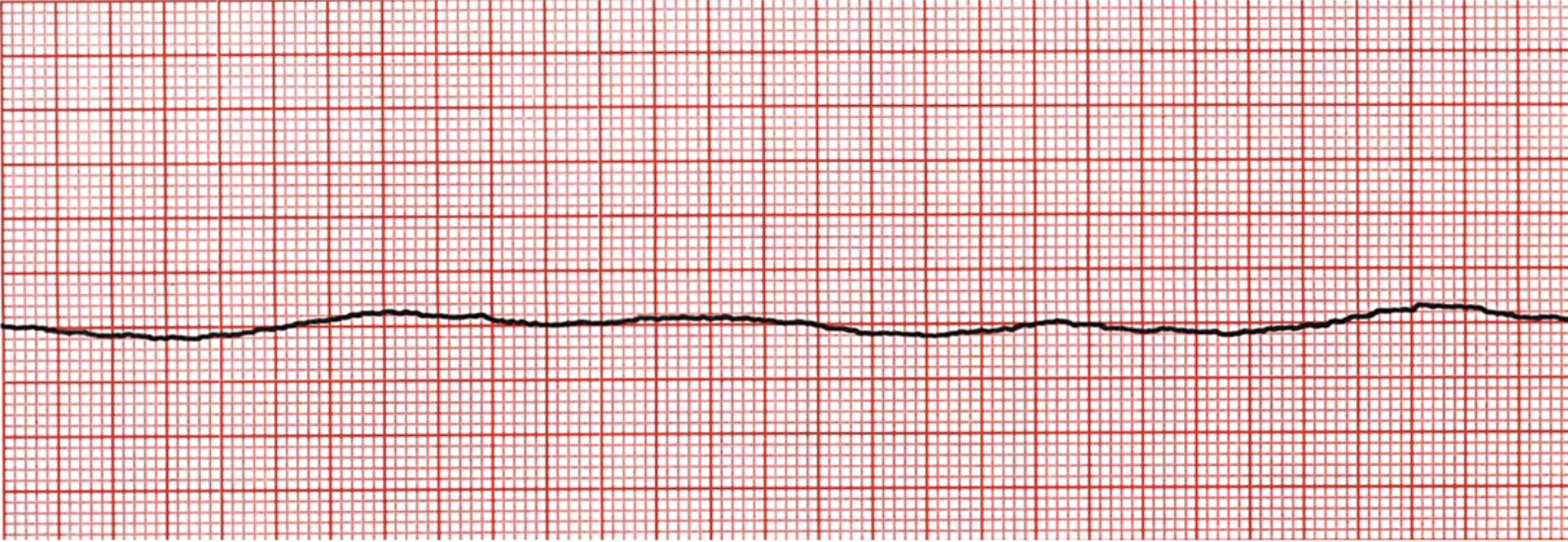 <p>What does this EKG represent?</p>