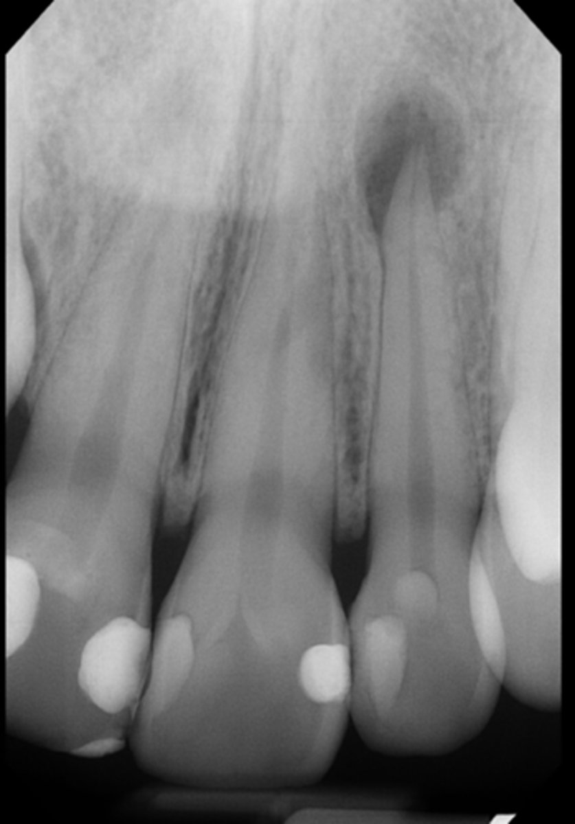 <p>ID the pulpal diagnosis:</p><p>- CC: "One of my teeth is darker than the others"</p><p>- Cold test: Negative (not responding)</p><p>- Radiograph shows tooth with intact pulp chamber (non-calcified) </p><p>- Rarification visible around apex</p><p>- Asymptomatic, blood supply nonexistent</p><p>- Pulpal nerves are nonfunctional</p>