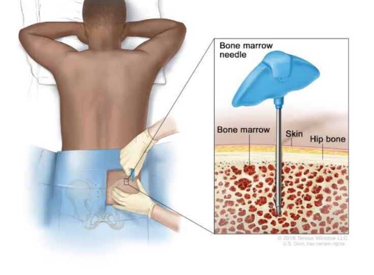 <p>It is obtained by penetrating the iliac crest or sternum with a large-bore needle and withdrawing a sample of the bone marrow. The sample is smeared on a slide and evaluated microscopically for cell-line precursors and iron stores. Bone marrow aspirates are used to diagnose anemia and leukemia</p>
