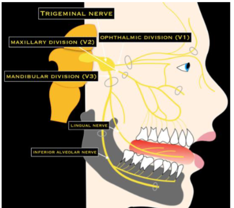 <ul><li><p>trigeminal </p></li><li><p>mixed</p></li><li><p>largest of the cranial nerves</p></li><li><p>motor- this nerve innervates the muscles of mastication</p><ul><li><p>relatively strong muscles of the face that are used in chewing</p></li></ul></li><li><p>sensory- nerve conveys sensory information from the anterior part of the tongue but not taste</p><ul><li><p>conveys sensory information about the cheeks, skin, and teeth </p></li></ul></li><li><p>Tic Douloureax/ trigeminal neuralgia- extremely painful condition with this nerve. MOST SEVERE PAIN in humans</p></li></ul><p></p>