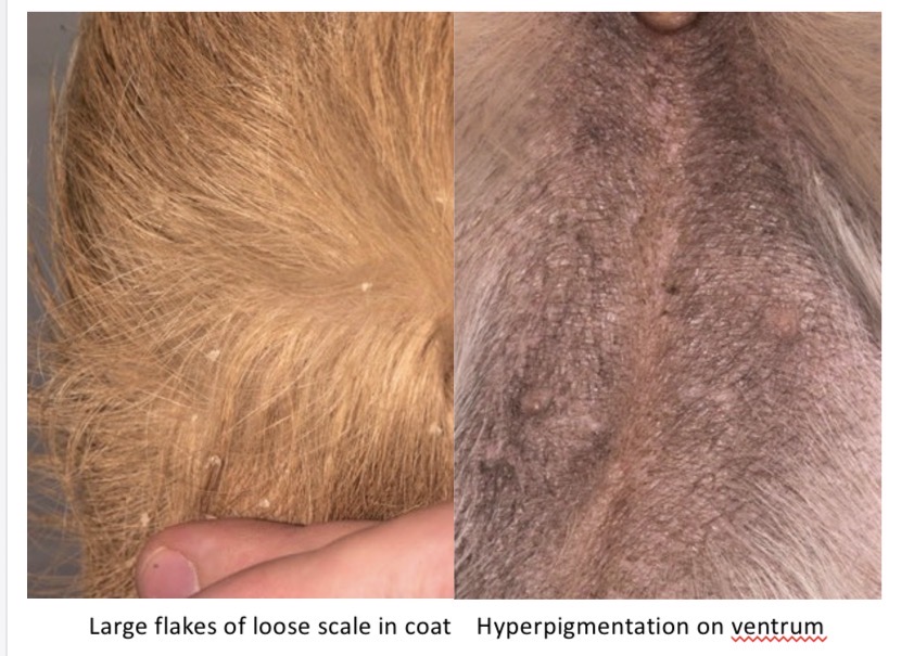 <p>Large flakes of non adherent scale, hyperpigmentation </p>