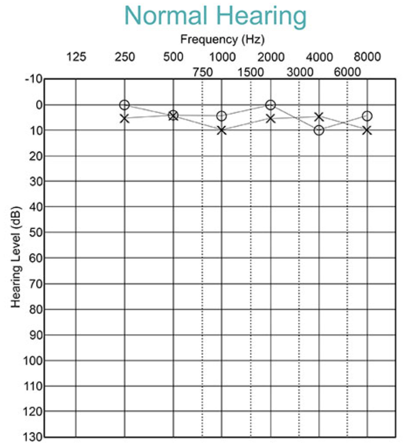 <ul><li><p>Thresholds below 15 dB HL at all frequencies </p></li><li><p>No significant difference between air & bone conduction </p></li><li><p>indicates optimal hearing sensitivity </p></li></ul><p></p>