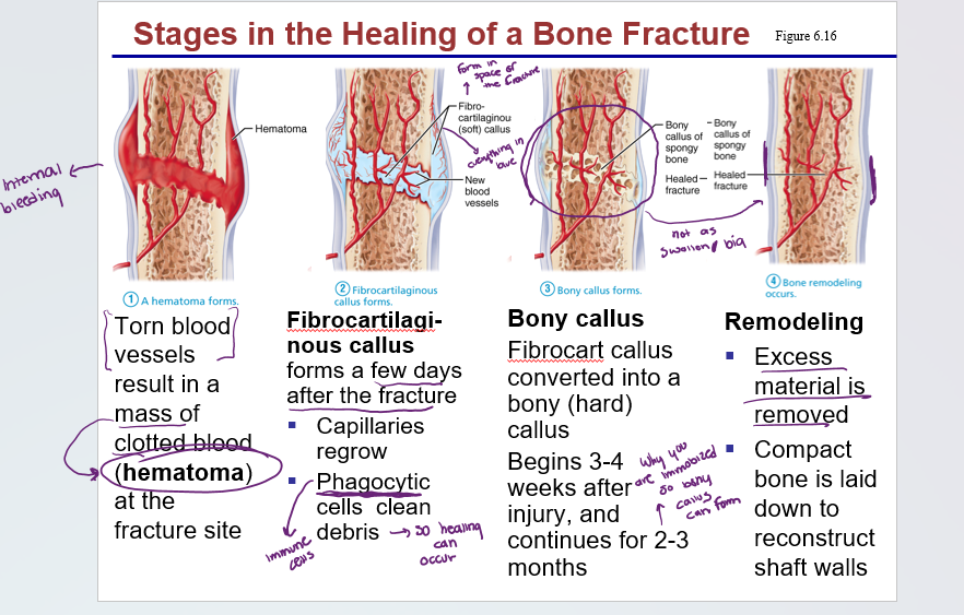 <p>1) hematoma forms </p><p>2) fibrocartilaginous callous forms</p><p>3) bony callus forms</p><p>4) bone remodeling occurs </p>