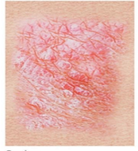 <p>flaking or shedding of the outer layer of skin, often small or large patches</p>