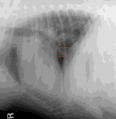 <p>2 ddx for caudal vena cava enlargement? </p>