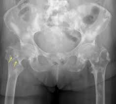 <p>are the most common malignant bone tumors. Are more common than primary neoplasms. Spread rom primary tumors by means of the bloodstream or lymphatic vessels or by direct extension. The most common primary tumors are carcinomas of \n the breast, lung, prostate, kidney, and thyroid. Favorite sites of metastatic spread are bones containing red marrow, such as the spine, pelvis, ribs, skull, and the upper ends of the humerus and femur.</p>