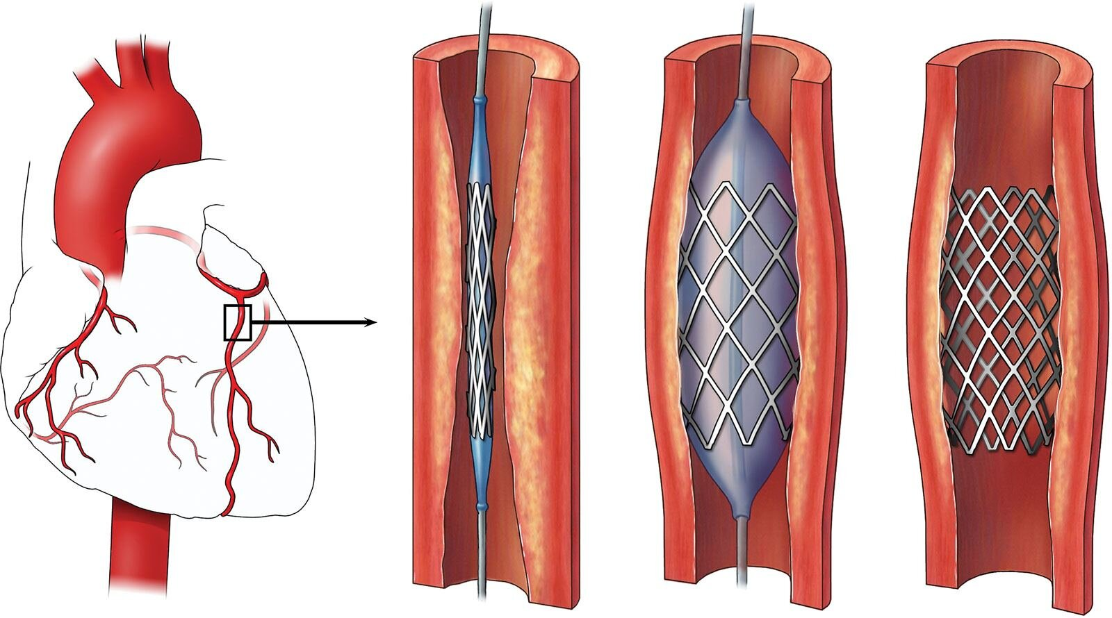 <p>Includes <strong>antiplatelet therapy (aspirin, ticagrelor) and anticoagulation </strong>to prevent further thrombus formation. In high-risk cases, more invasive procedures like <strong>percutaneous coronary intervention (PCI)</strong> may be necessary.</p><p><strong>Percutaneous Coronary Intervention (PCI):</strong> A procedure to open narrowed or blocked coronary arteries using a catheter with a balloon or stent to restore blood flow to the heart muscle.</p>