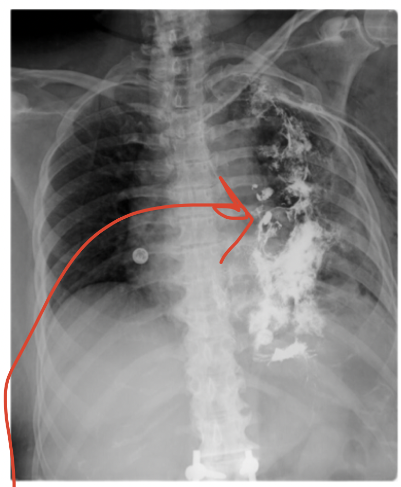 <p>Imaging for Boerhaave Syndrome</p>