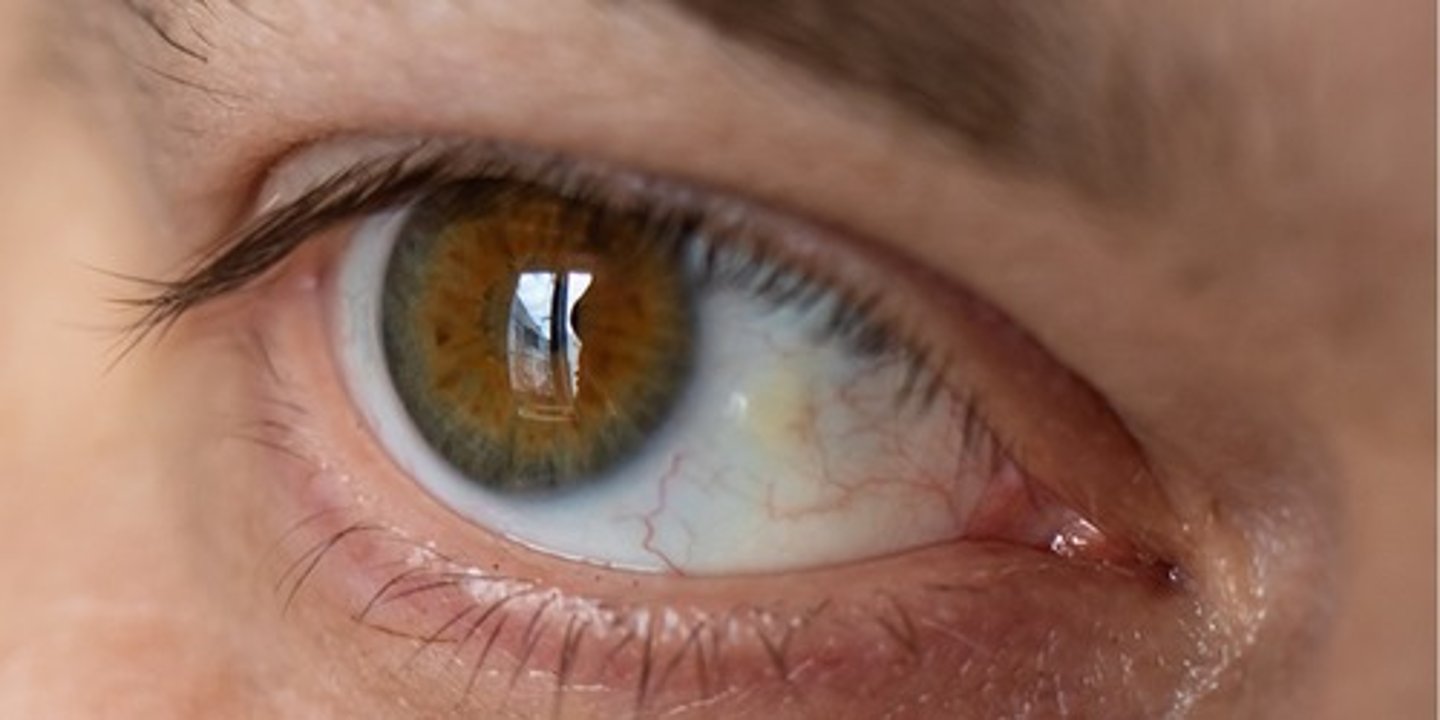 <p>benign connective tissue overgrowth that appears yellow and doesn't normally affect vision</p>