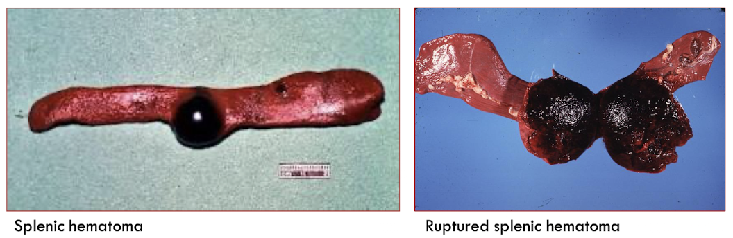 <p>FALSE - can be insignificant or rupture &amp; potentially cause death</p>