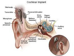 - for those with no cochlear function
- external sound processor and transmitter (attached to side of head) 
- internal receiver and electronic "cochlea" 
- must learn to interpret these "sounds" 
- not like typical hearing
