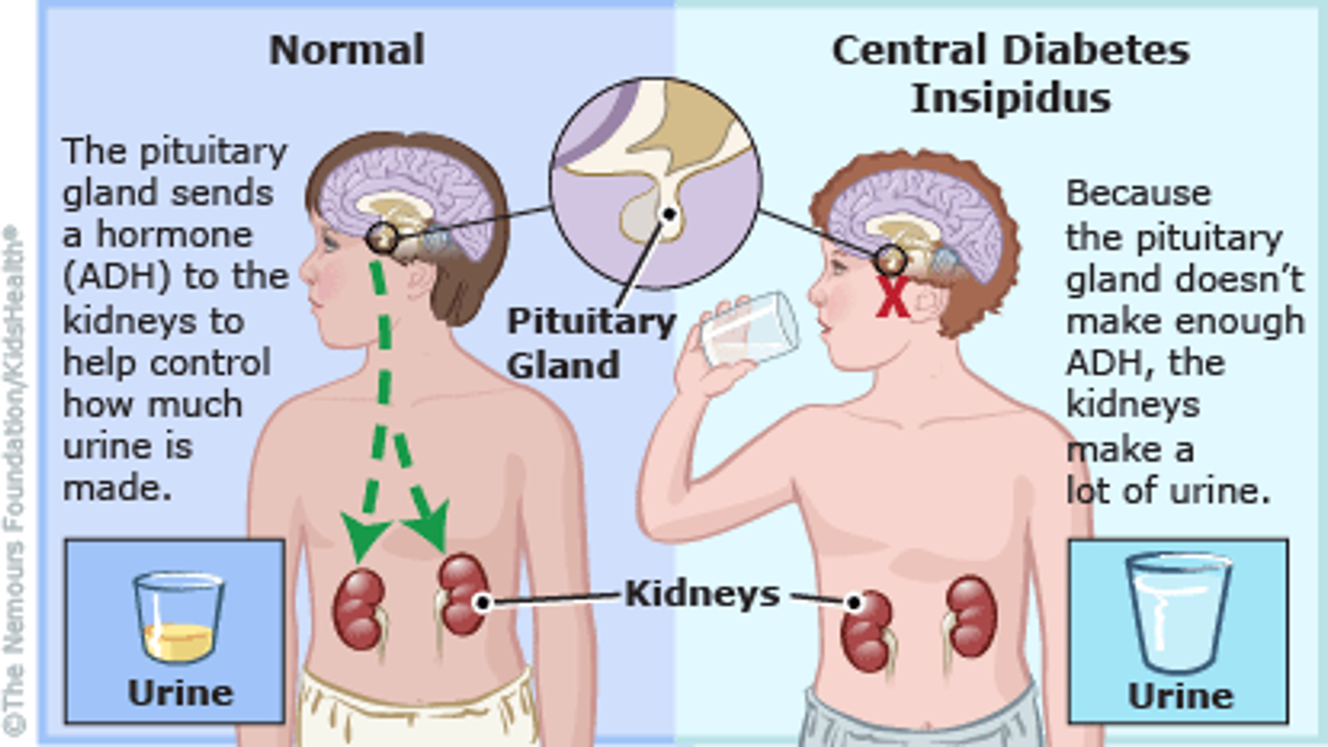 <p>Diabetes Insipidus</p>