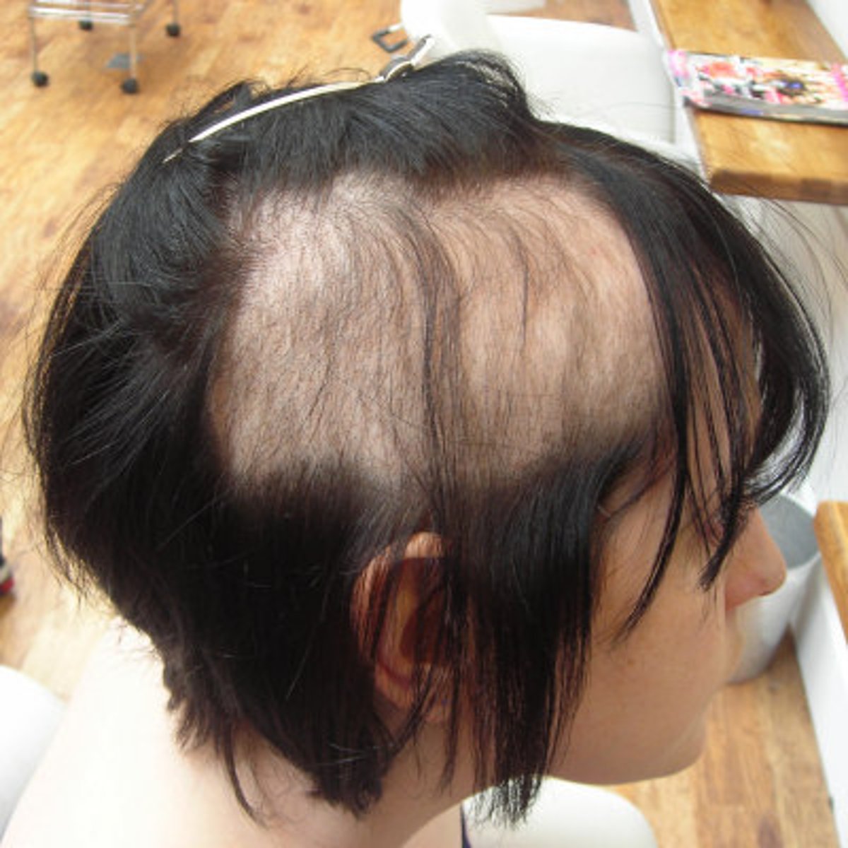 <p>hair pulling disorder, associated with psych conditions</p>