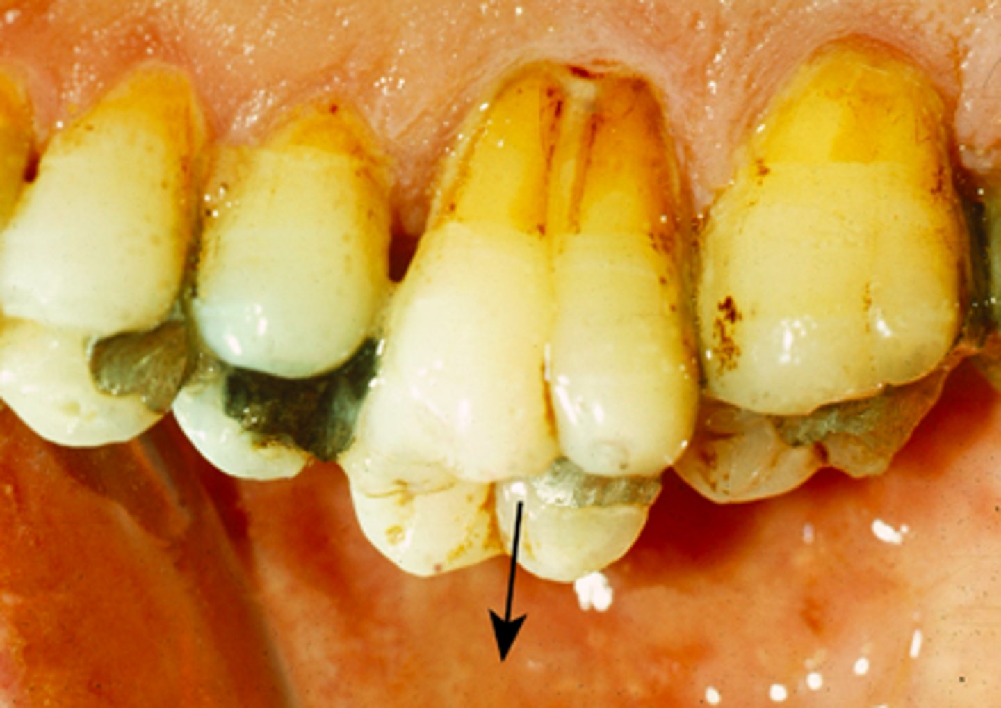 <p>Elongated above the line of occlusion</p>