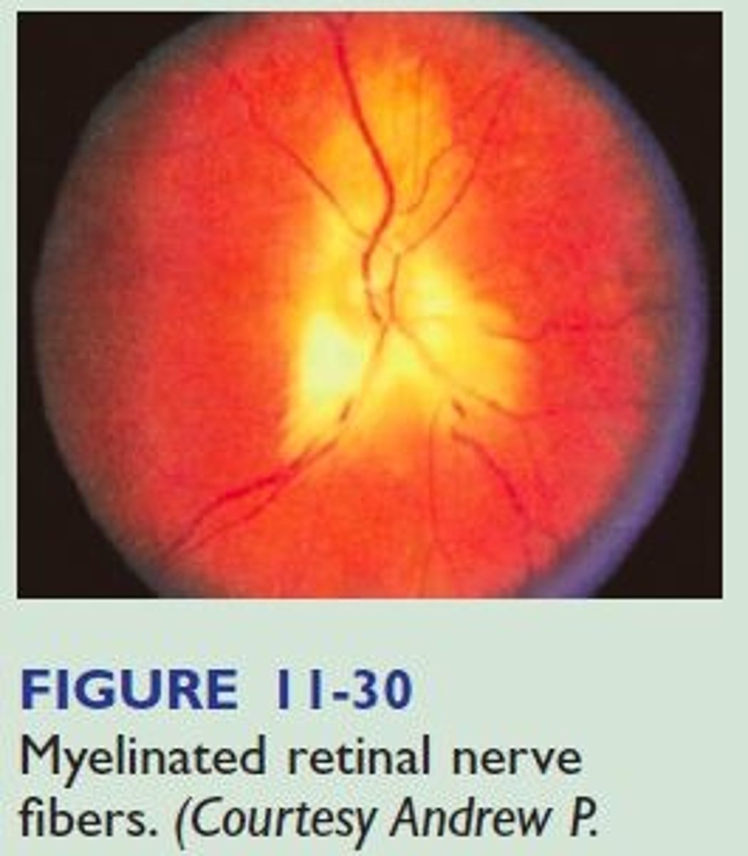 <p>Myelinated retinal nerve; no physiologic signifcance</p>