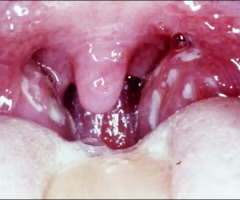 <p>fluid secreted by the tonsils in response to infection or inflammation</p>